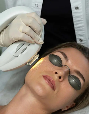 Máy triệt lông bằng laser OPT 615nm Trị mụn trẻ hóa mạch máu Photon Ipl